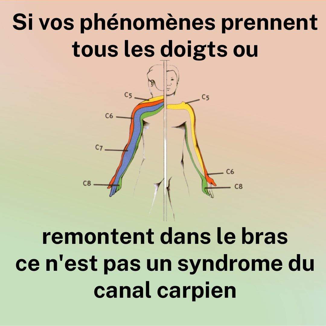 Si vos phénomènes prennent tous les doigts ou remontent dans le bras, ce n'est pas un syndrome du canal carpien. Schéma des territoires nerveux du bras, de C5 à C8.