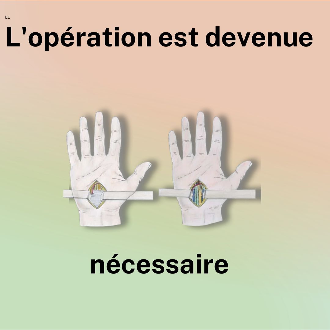 … l'opération est devenue nécessaire. Illustration de deux mains ouvertes au niveau du poignet : le ligament avant, puis après sa section.